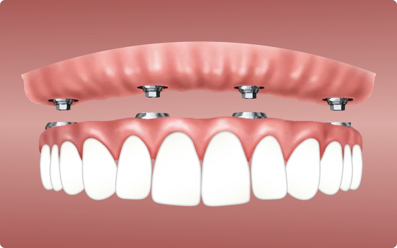 imagen de unos implantes dentales animados