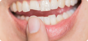 persona enseñando los dientes