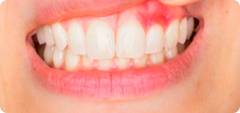 persona enseñando los dientes