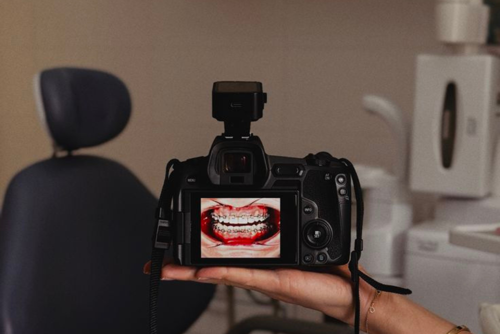 porcelain veneers in Tijuana