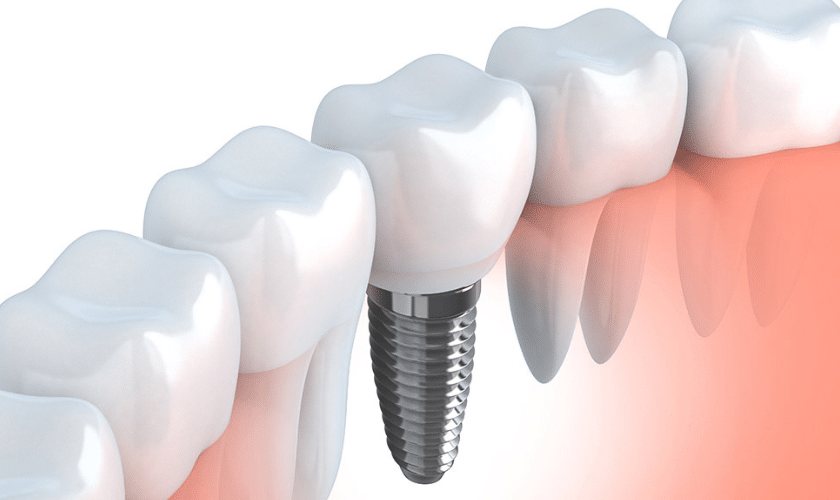 Advanced Dental Implants