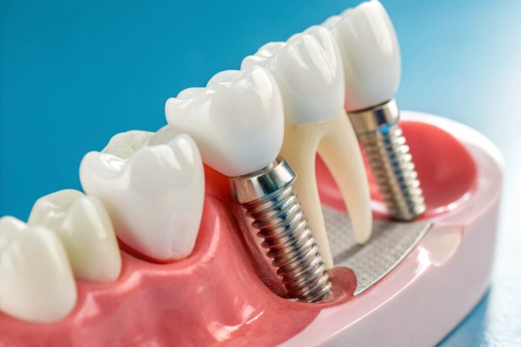 Dental Implant Recovery
