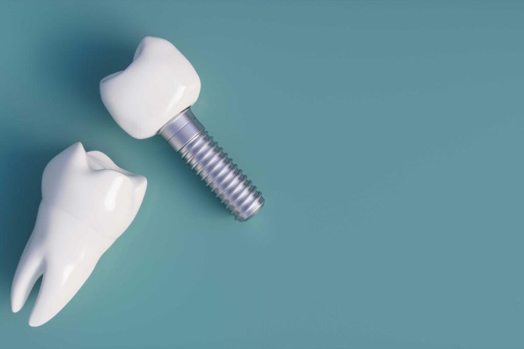 Dental Implants