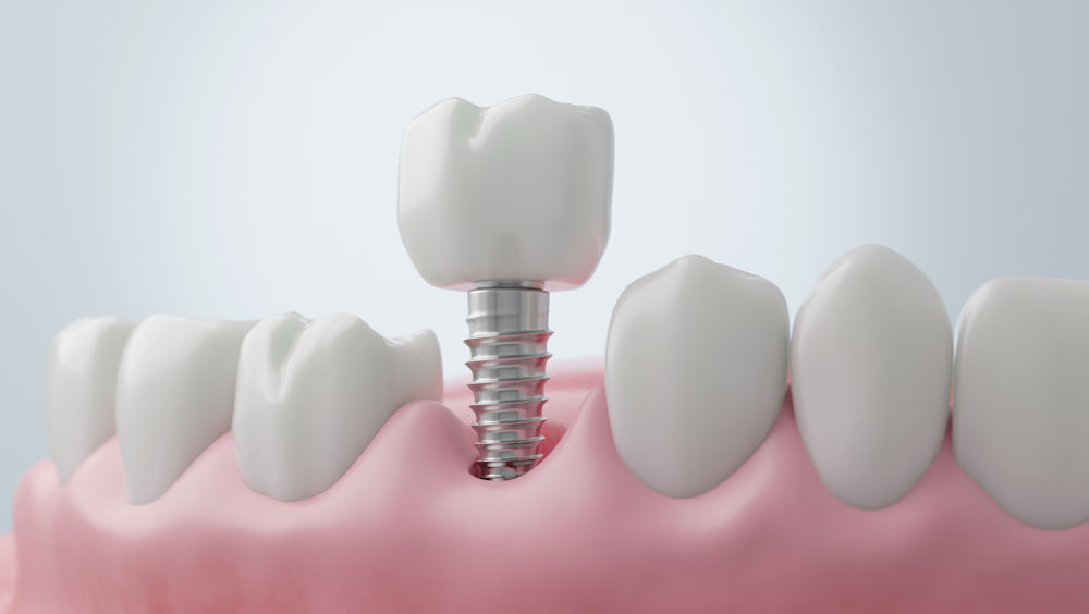implant-supported
